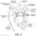 Fig. 03 - Loading systems for collapsible prosthetic heart valve devices and methods thereof