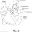 Fig. 04 - Loading systems for collapsible prosthetic heart valve devices and methods thereof