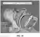Fig. 11 - SYSTEMS AND METHODS FOR OBSTRUCTIVE SLEEP APNEA DETECTION AND MONITORING