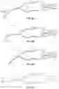 Fig. 06 - OPHTHALMOLOGICAL SURGERY MICROSURGERY INSTRUMENTS AND METHODS OF USE IN PARS PLANA VITRECTOMY FOR INCREASING SURGICAL PRECISION AND REDUCING VITREORETINAL INSTRUMENT INSERTIONS AND REMOVALS AND RELATED TRAUMA