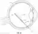 Fig. 17 - OPHTHALMOLOGICAL SURGERY MICROSURGERY INSTRUMENTS AND METHODS OF USE IN PARS PLANA VITRECTOMY FOR INCREASING SURGICAL PRECISION AND REDUCING VITREORETINAL INSTRUMENT INSERTIONS AND REMOVALS AND RELATED TRAUMA