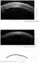 Fig. 04 - Endothelial ocular implant