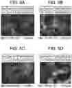Fig. 07 - DRY POWDER FORMULATIONS CONTAINING LEUCINE AND TRILEUCINE