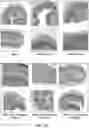 Fig. 13 - METHODS FOR TREATING INFLAMMATORY BOWEL DISEASE