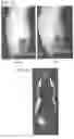 Fig. 31 - REFILLABLE DRUG DELIVERY DEVICES AND METHODS OF USE THEREOF