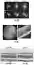 Fig. 10 - OPTIDICER CONSTRUCT FOR AGE-RELATED MACULAR DEGENERATION
