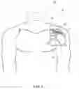 Fig. 04 - TISSUE REPAIR IMPLANT AND COMPOSITIONS AND METHOD OF IMPLANTATION