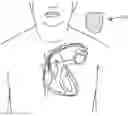 Fig. 01 - HEMOSTATIC DEVICES AND METHODS OF USE