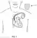 Fig. 02 - HEMOSTATIC DEVICES AND METHODS OF USE