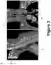 Fig. 04 - IMAGING-BASED SIZING OPTIMIZATION OF ENDOTRACHEAL TUBE FOR MECHANICAL VENTILATION