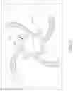 Fig. 65 - MEDICAL BALLOON CATHETERS WITH ENHANCED PUSHABILITY
