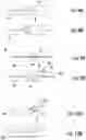 Fig. 11 - SYSTEMS AND METHODS FOR SELECTIVELY OCCLUDING THE SUPERIOR VENA CAVA FOR TREATING HEART CONDITIONS