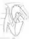 Fig. 61 - SYSTEMS AND METHODS FOR SELECTIVELY OCCLUDING THE SUPERIOR VENA CAVA FOR TREATING HEART CONDITIONS