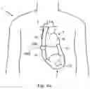 Fig. 04 - HEART HELP PUMP, SYSTEM, AND METHOD