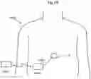 Fig. 19 - HEART HELP PUMP, SYSTEM, AND METHOD