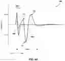 Fig. 05 - LATENCY COMPENSATION FOR DETECTION OF ECAPS