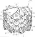 Fig. 01 - PROSTHETIC HEART VALVE LEAFLET COMMISSURE ASSEMBLIES AND METHODS