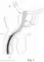 Fig. 02 - URINARY CATHETERS AND METHODS FOR PREVENTING BACTERIAL INFECTIONS