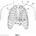 Fig. 02 - Implantable electrical leads and associated delivery systems