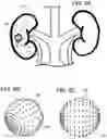 Fig. 07 - INTRA-KIDNEY STONE DISRUPTOR