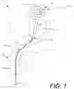 Fig. 02 - COIL CATHETER, METHOD OF USE, AND METHOD OF MANUFACTURE