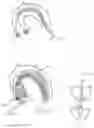 Fig. 10 - TRANSCATHETER VALVE LACERATION DEVICE AND METHOD