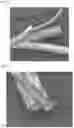 Fig. 05 - MULTIPLE STENT WITH MEMBRANE