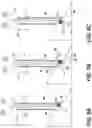 Fig. 09 - Anti-skive bone drill