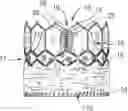 Fig. 01 - MULTI-LAYER COVERING FOR A PROSTHETIC HEART VALVE