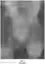 Fig. 02 - Thermal Imaging Device Performing Image Analysis To Facilitate Early Detection Of Distal Extremity Altered Perfusion States