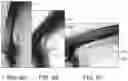Fig. 06 - Absorbable intravascular devices that shorten upon expansion creating space for vascular movement