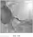 Fig. 15 - Absorbable intravascular devices that shorten upon expansion creating space for vascular movement