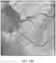 Fig. 16 - Absorbable intravascular devices that shorten upon expansion creating space for vascular movement