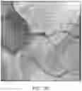 Fig. 17 - Absorbable intravascular devices that shorten upon expansion creating space for vascular movement