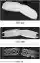 Fig. 19 - Absorbable intravascular devices that shorten upon expansion creating space for vascular movement