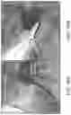 Fig. 20 - Absorbable intravascular devices that shorten upon expansion creating space for vascular movement