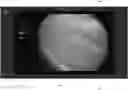 Fig. 01 - Systems and methods for detection and analysis of polyps in colon images