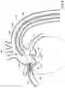 Fig. 06 - OSTIAL STENT DELIVERY DEVICE, SYSTEM, AND METHOD