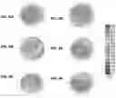 Fig. 09 - TREATMENT OF THE CORNEA USING CROSSLINKING AND MECHANICAL LOAD