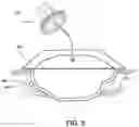 Fig. 06 - Apparatus for cutting a material and a method for cutting a negative pressure wound therapy dressing