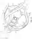 Fig. 02 - Device and method for removing material from a hollow anatomical structure