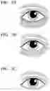 Fig. 04 - COSMETIC PROCESS USING MICRONEEDLE SHEET