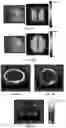 Fig. 06 - METHODS AND APPARATUSES FOR DELIVERING TUMOR TREATING FIELDS TO A SUBJECT'S BODY FOR NEAR-SURFACE TUMORS