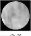 Fig. 53 - Systems for Sacroiliac Joint Stabilization