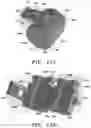 Fig. 65 - Systems for Sacroiliac Joint Stabilization