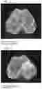 Fig. 07 - BONE GRAFT COMPOSITION