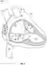 Fig. 02 - MEDICAL DEVICE WITH ANGLED HEADER AND DELIVERY SYSTEM