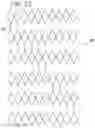 Fig. 13 - EXPANDABLE SHEATH FOR INTRODUCING AN ENDOVASCULAR DELIVERY DEVICE INTO A BODY
