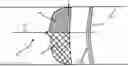 Fig. 01 - EMBOLISATION SYSTEM FOR PROMOTING CLOT FORMATION