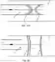 Fig. 02 - EMBOLISATION SYSTEM FOR PROMOTING CLOT FORMATION